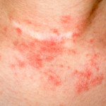 eczema skin on neck