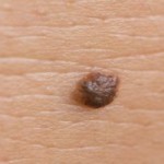 intradermal nevus